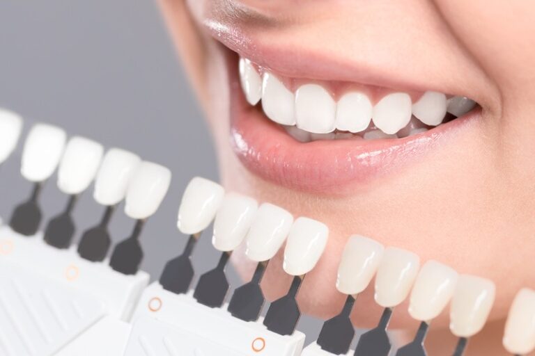 carillas-dentales