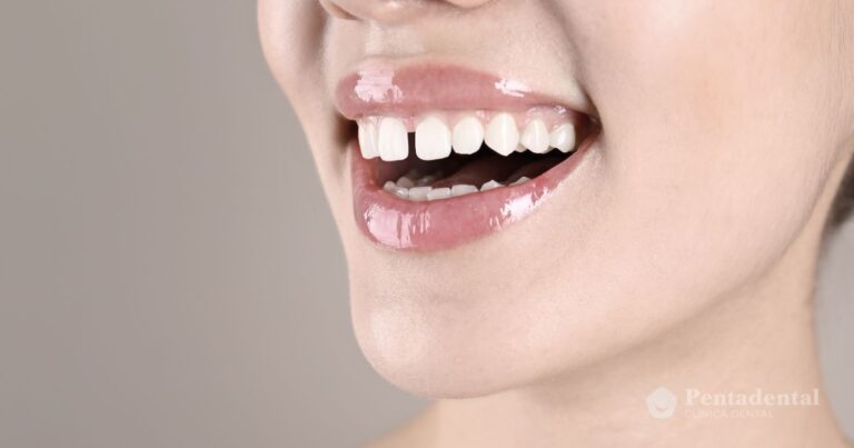 cerrar-espacios-entre-dientes-con-carillas