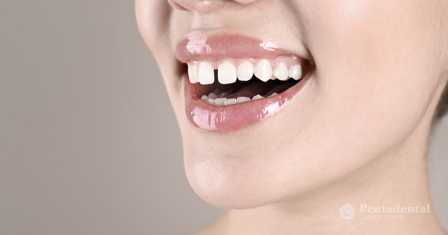 cerrar-espacios-entre-dientes-con-carillas
