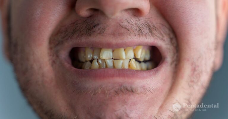 dientes-manchados-tetracliclinas