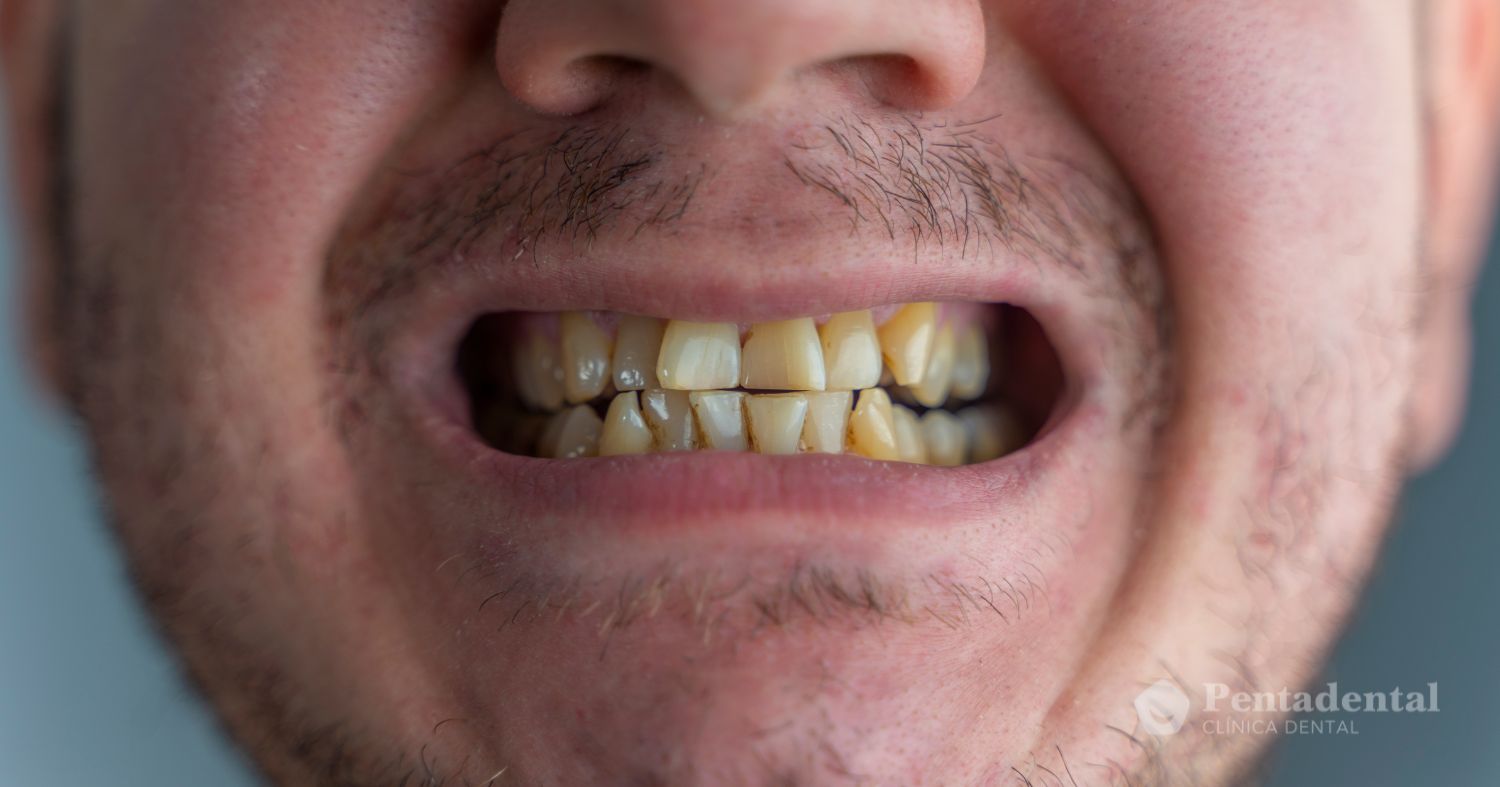 dientes-manchados-tetracliclinas