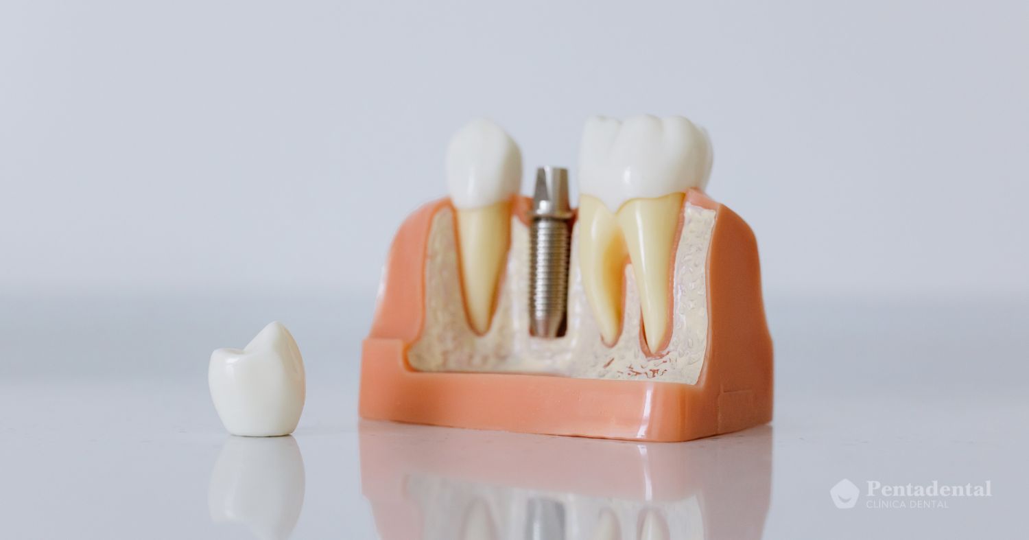 Mantenimiento de implantes