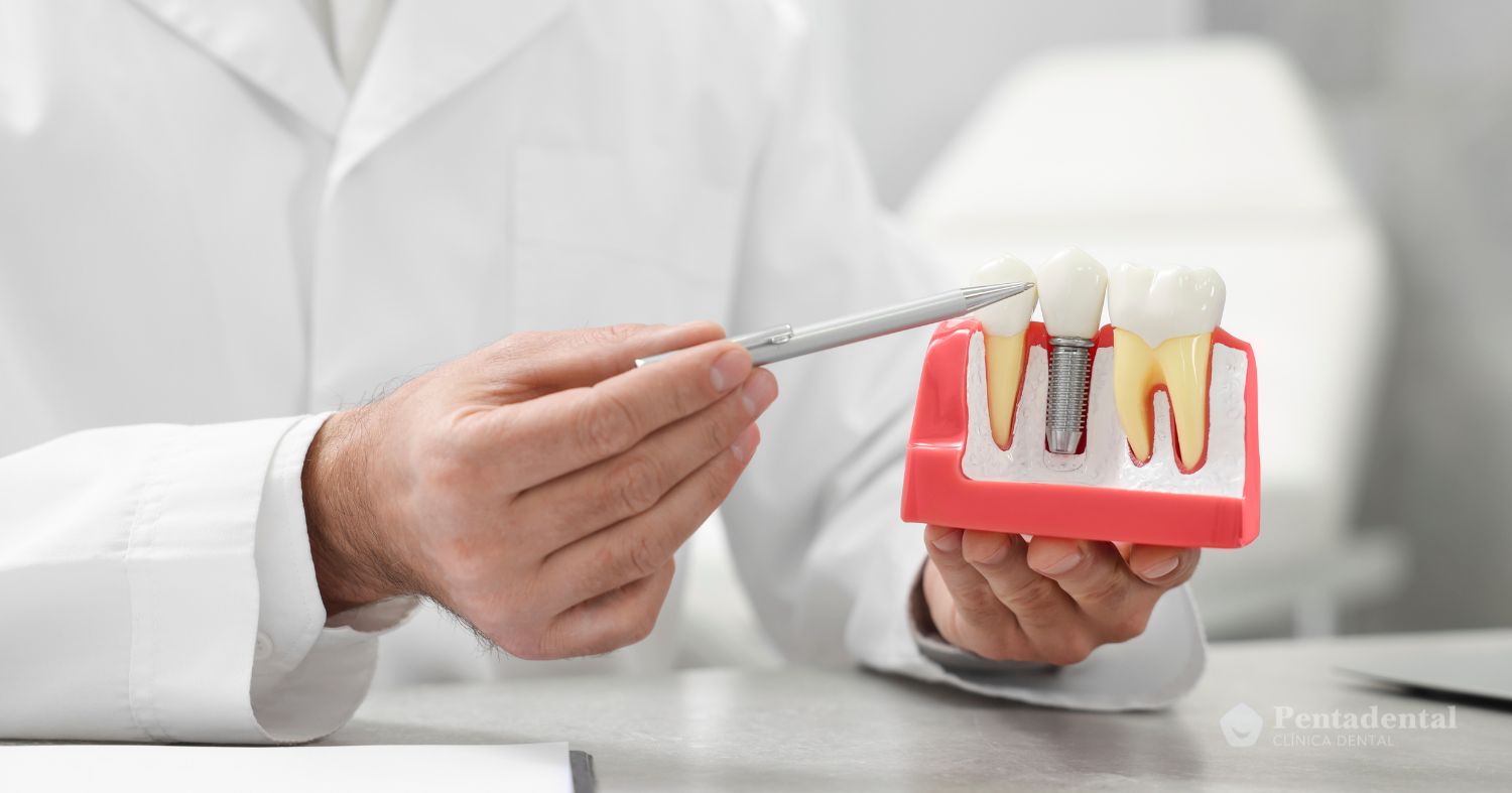implantes-carga-inmediata-en-viladecans