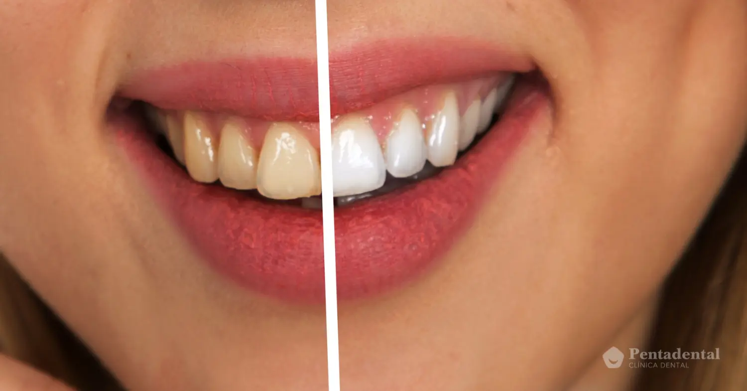 Antes y después de blanqueamiento dental