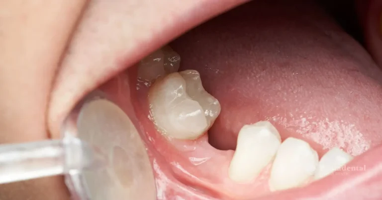 Boca a la que le falta un diente por agenesia dental