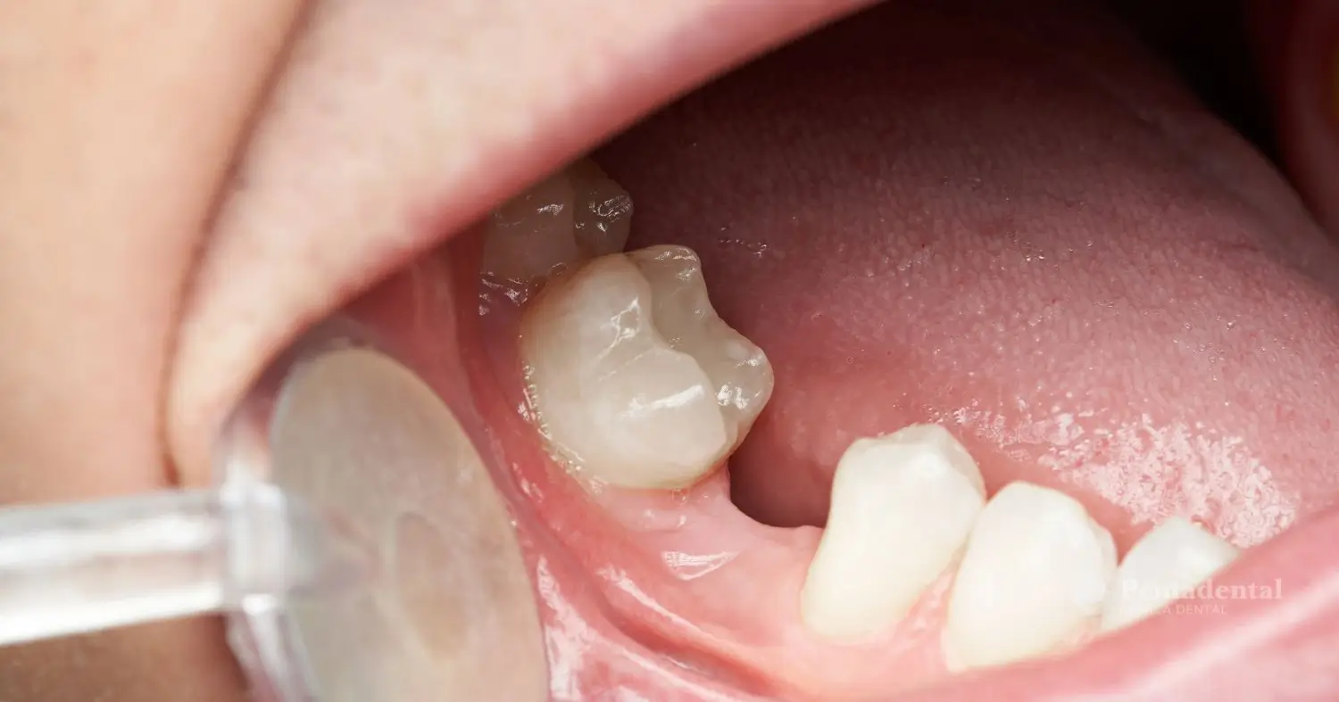Boca a la que le falta un diente por agenesia dental