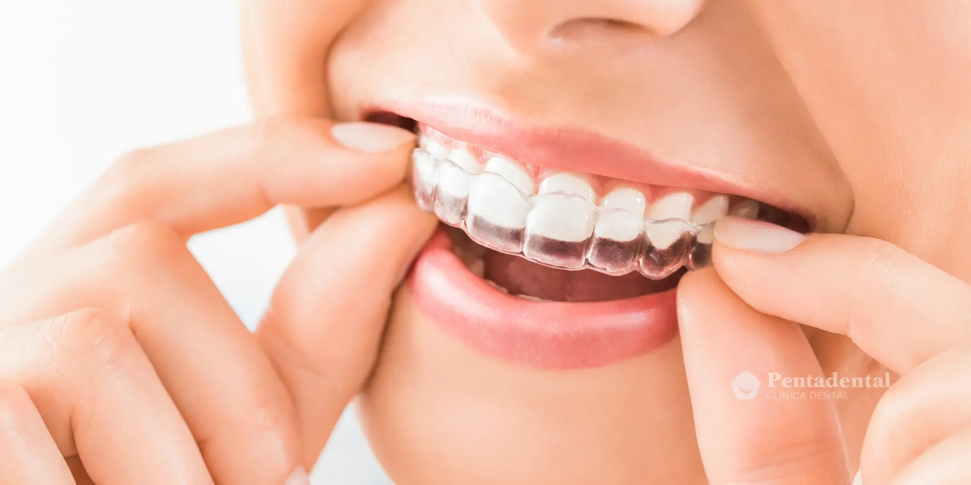 Paciente colocando alineadores de ortodoncia invisible en los dientes