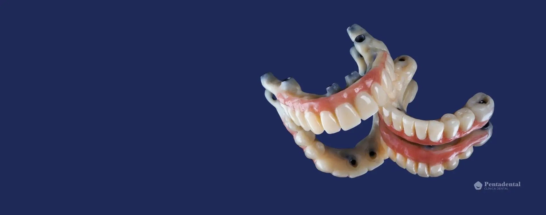Prótesis dentales fijas completas