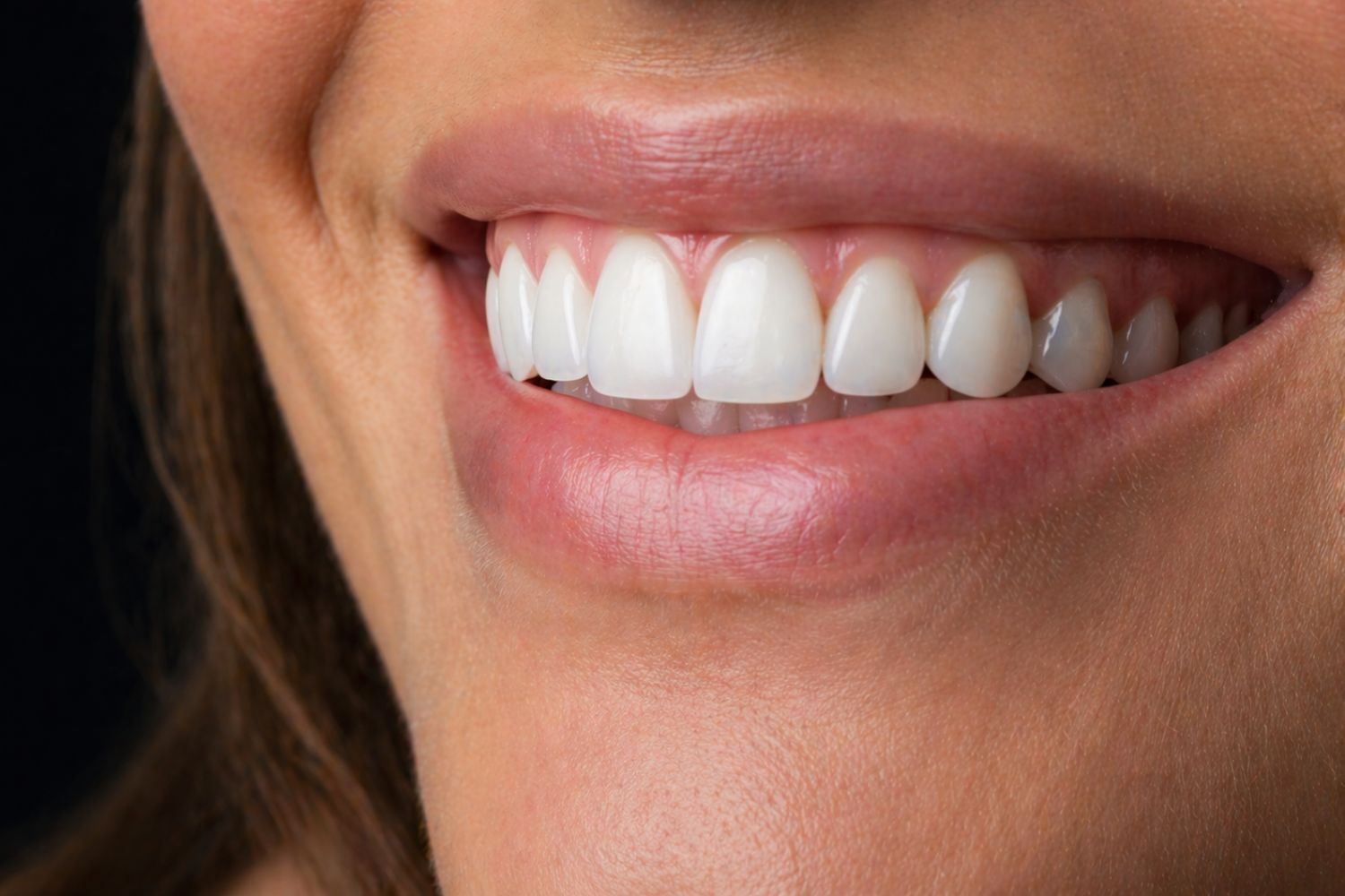 microcarillas-dentales-sin-tallado-en-viladecans
