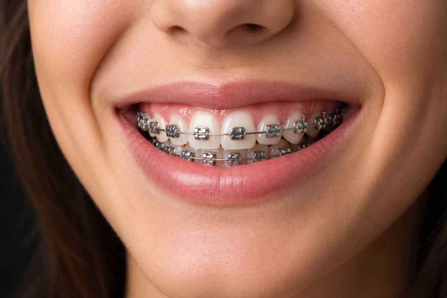 ortodoncia-con-brackets-autoligables-en-viladecans