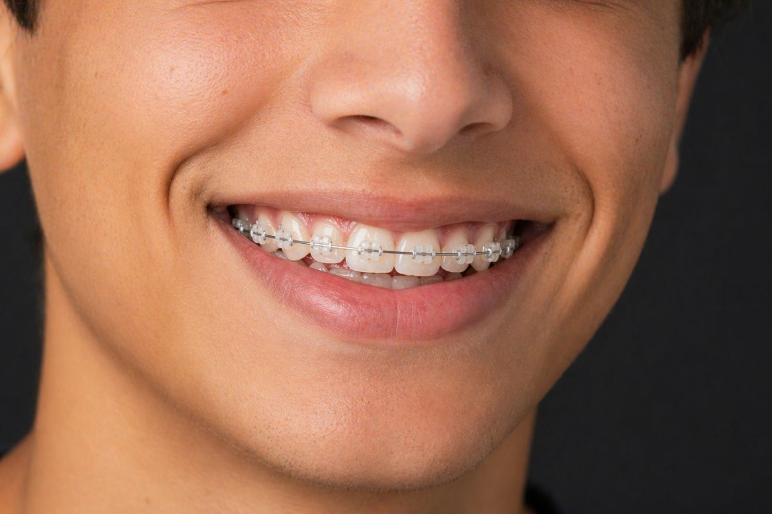 ortodoncia-con-brackets-en-viladecans-clinica-pentadental