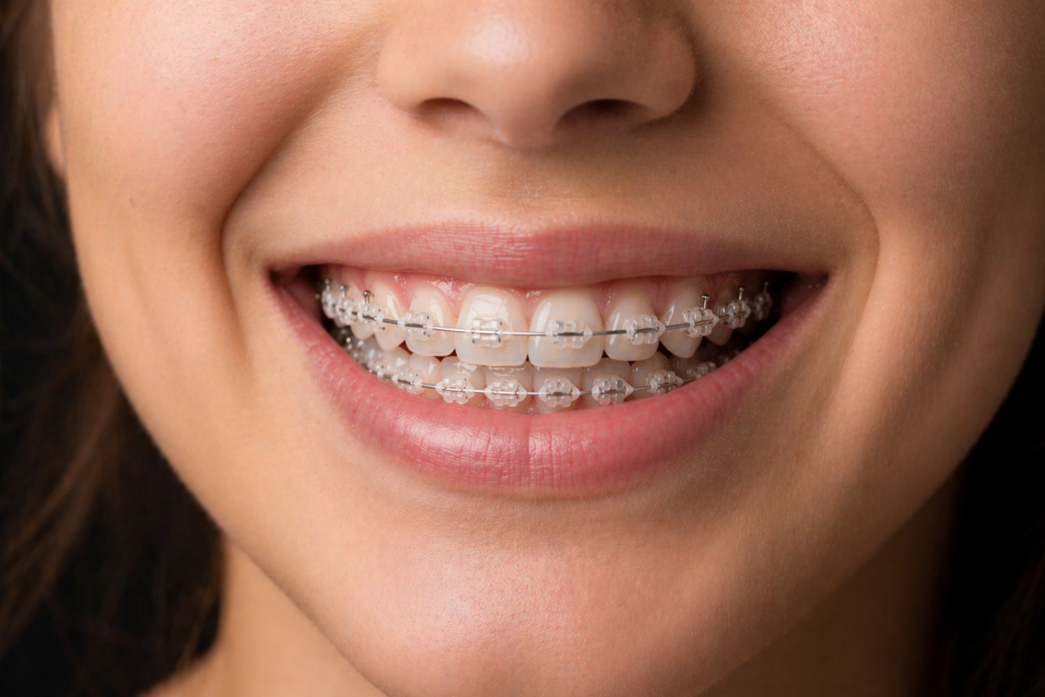 ortodoncia-con-brackets-esteticos-en-viladecans