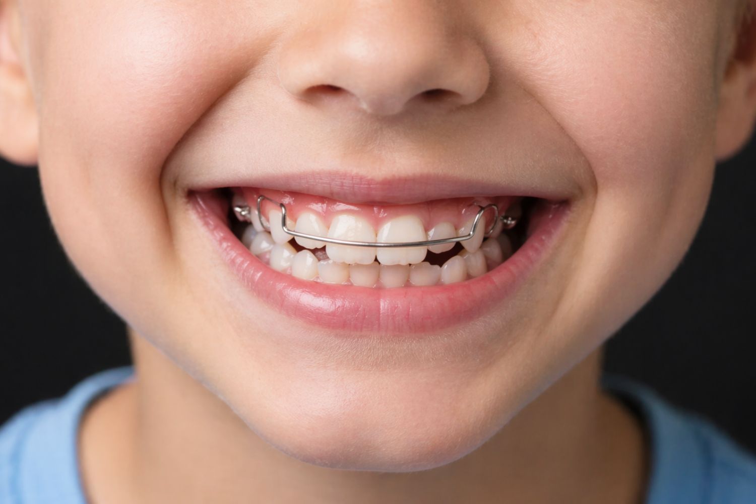 ortodoncia-infantil-en-viladecans-clinica-pentadental