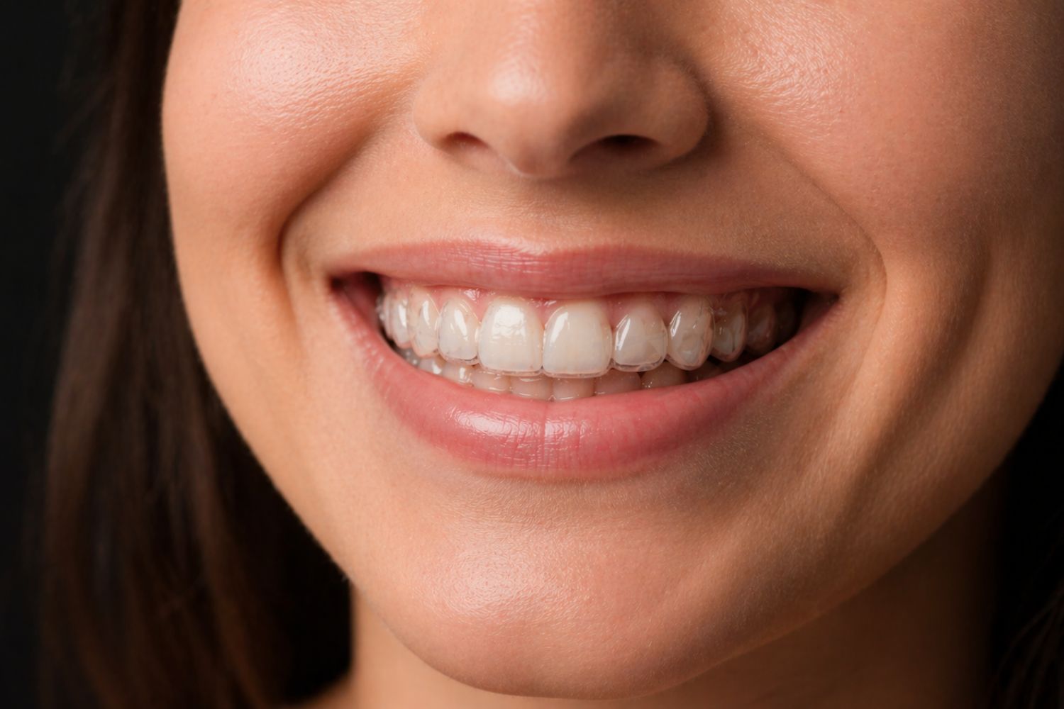 ortodoncia-invisible-para-adultos-en-viladecans-clinica-pentadental
