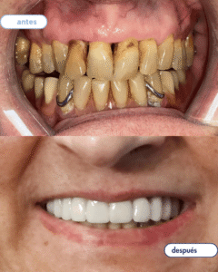 antes-despues implantes 1