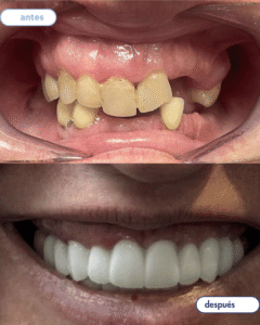 antes-despues implantes 2