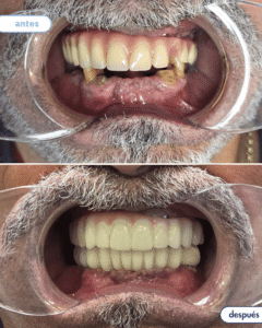 antes-despues implantes 3