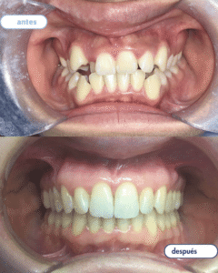 antes-despues ortodoncia 1