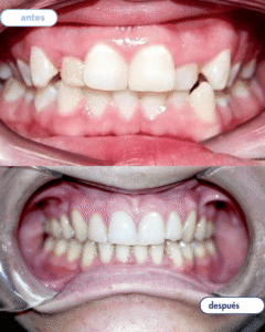 antes-despues ortodoncia 2