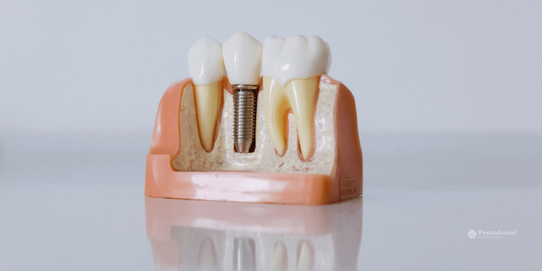 implantes dentales con diabetes
