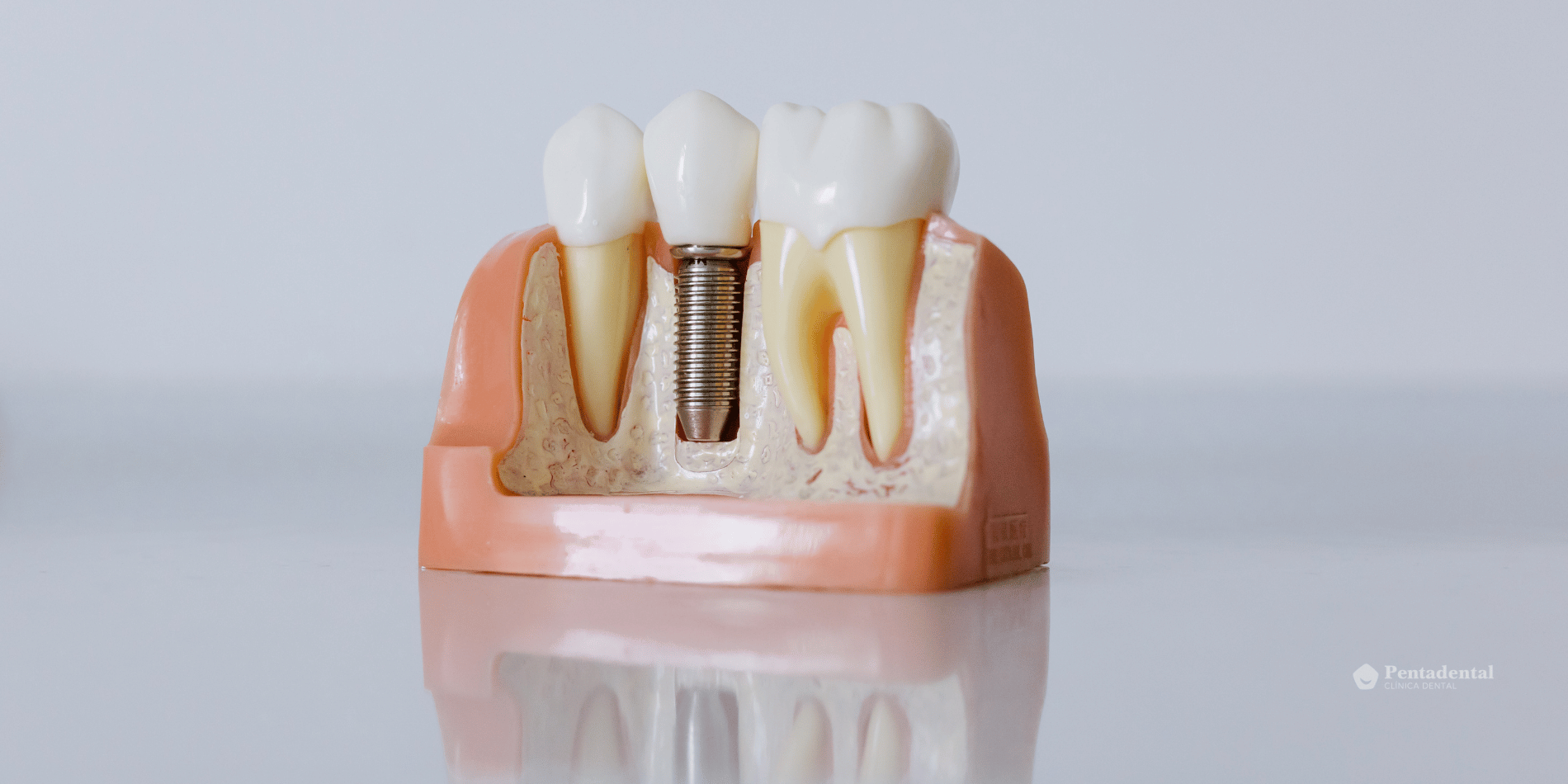 implantes dentales con diabetes