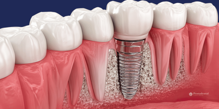 cirugía guiada implantes